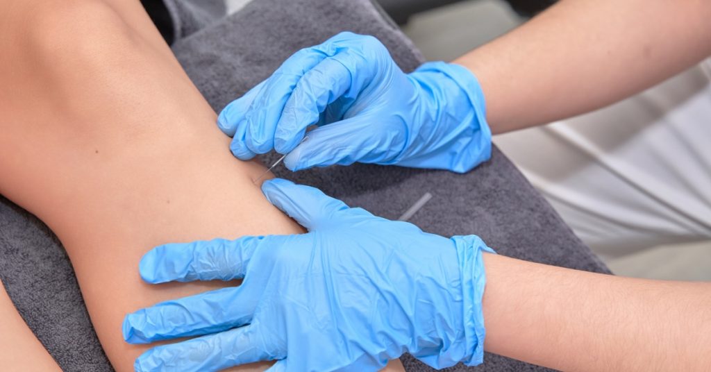 acupuncture vs dry needling