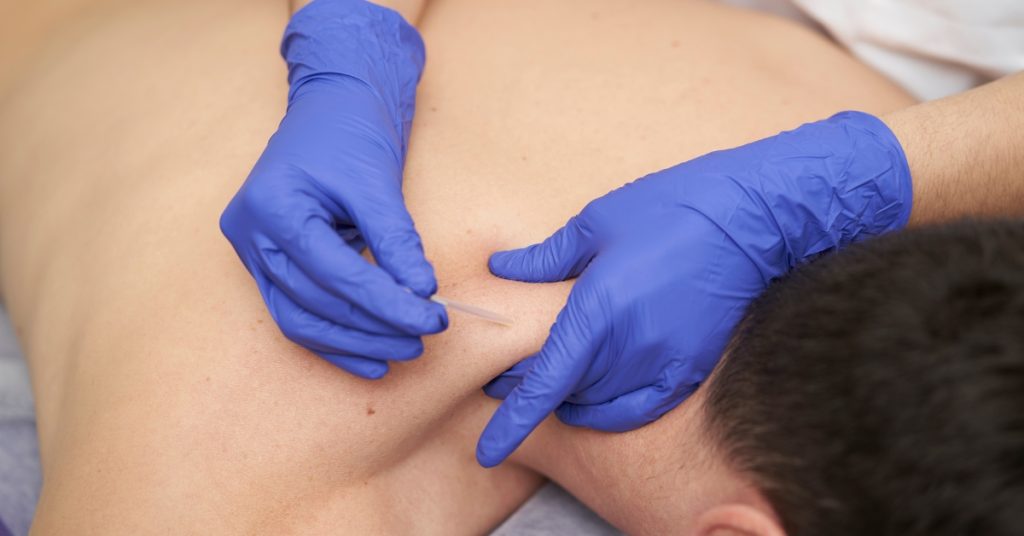 acupuncture vs dry needling