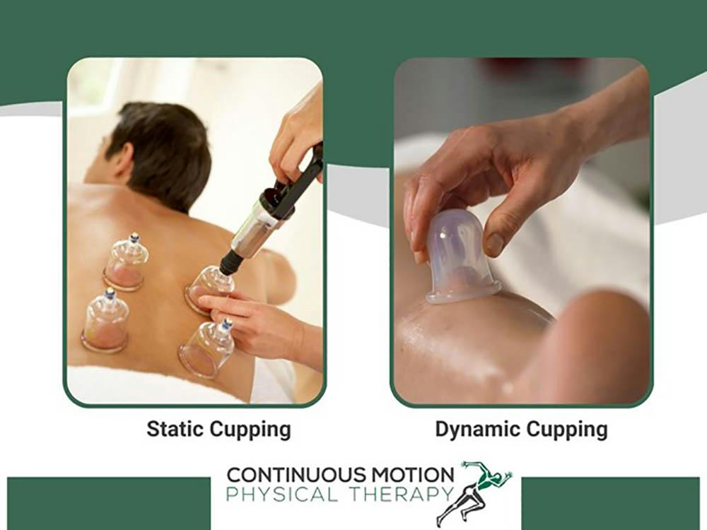 Static and dynamic cupping.