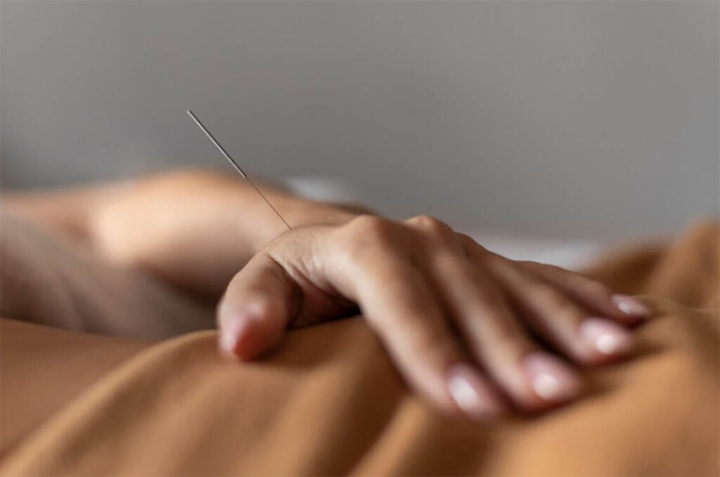 What to Expect During a Dry Needling Session