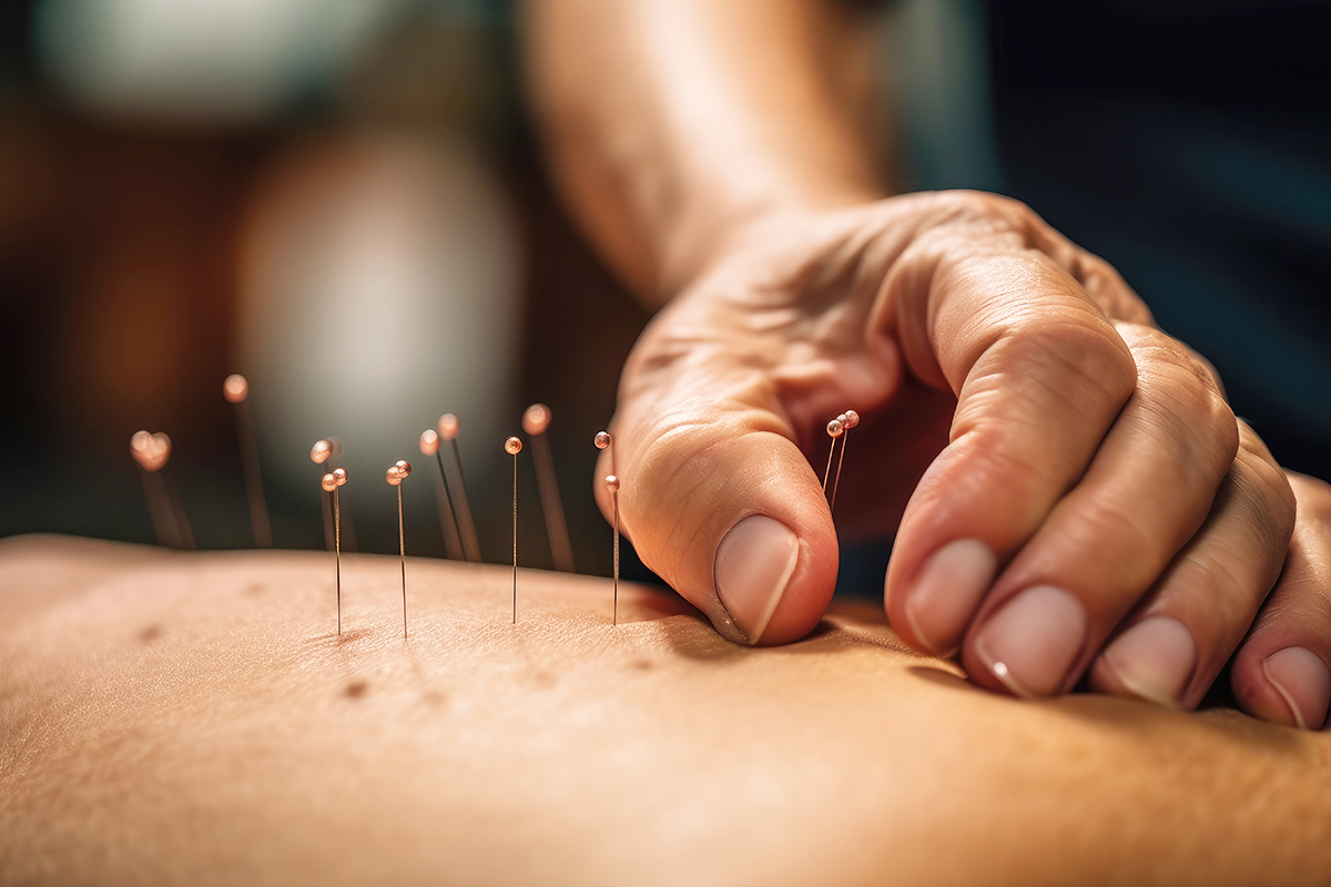 What Happens After a Dry Needling Procedure