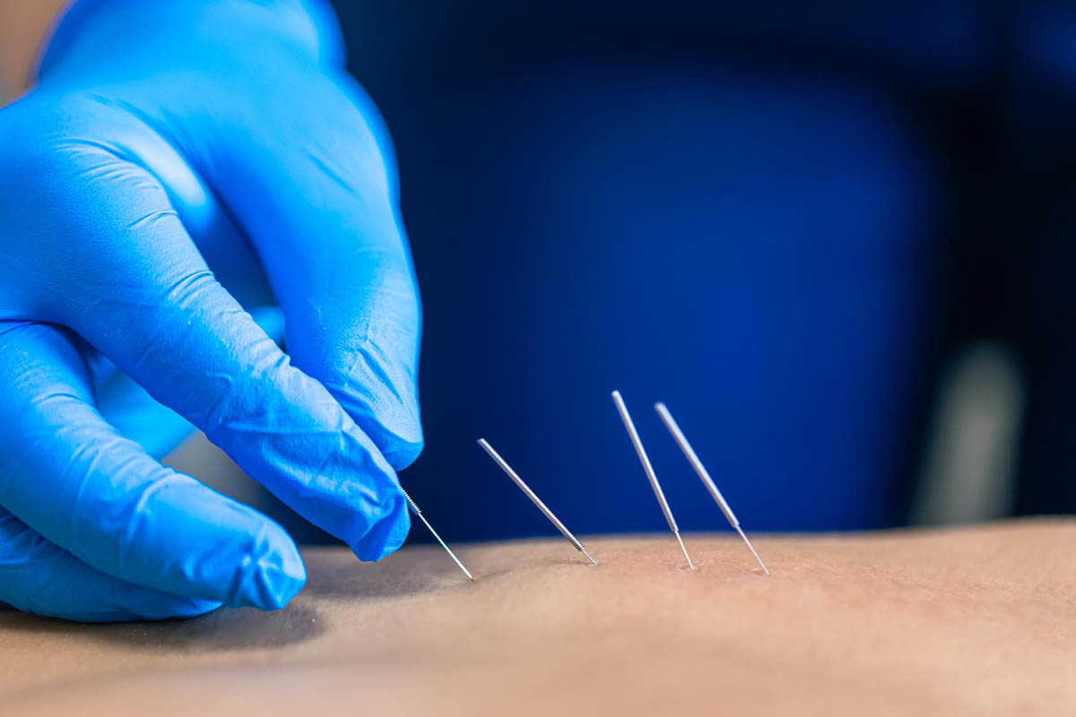 What You Need to Know About Dry Needling for Pelvic Floor
